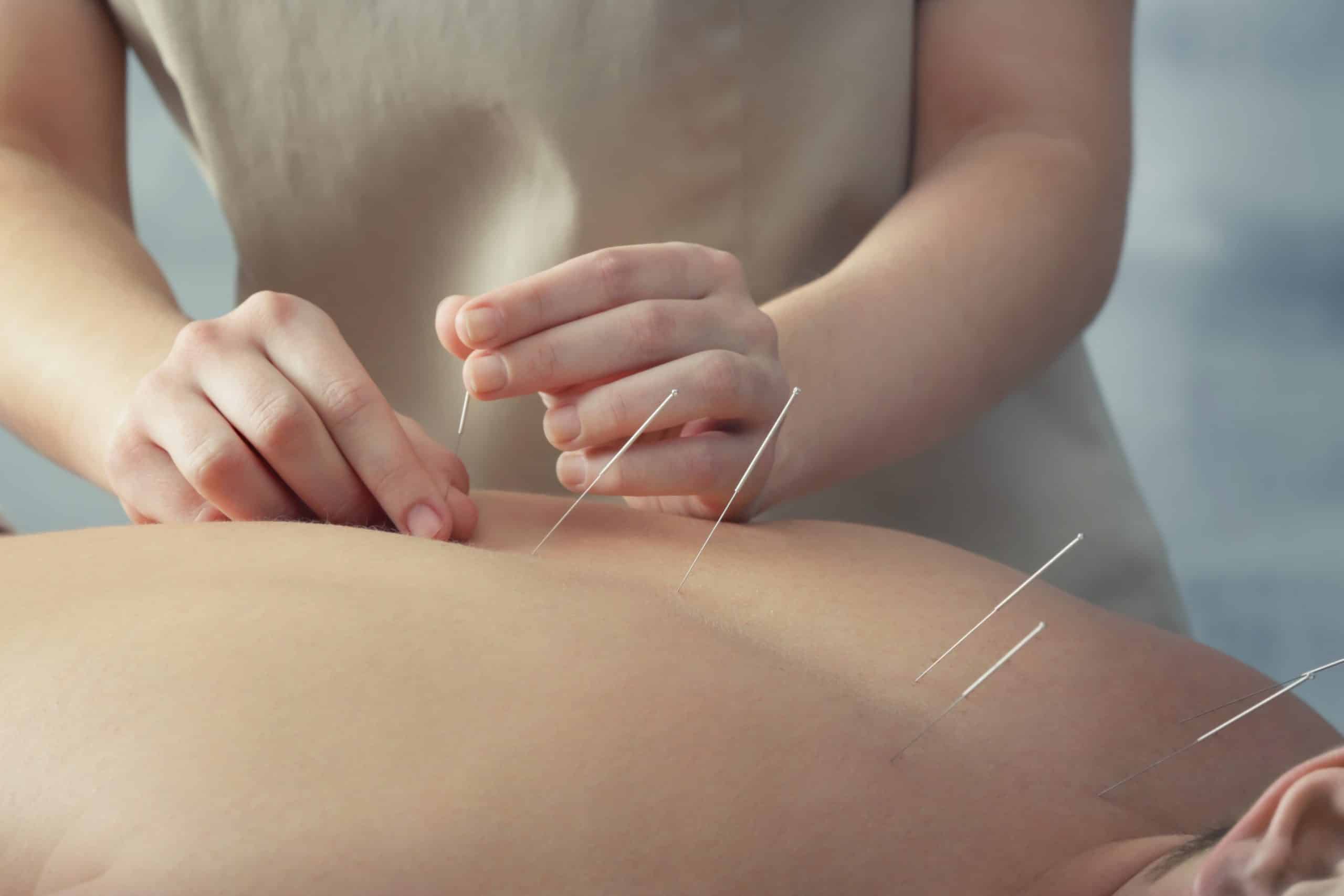 Young man getting acupuncture treatment, closeup